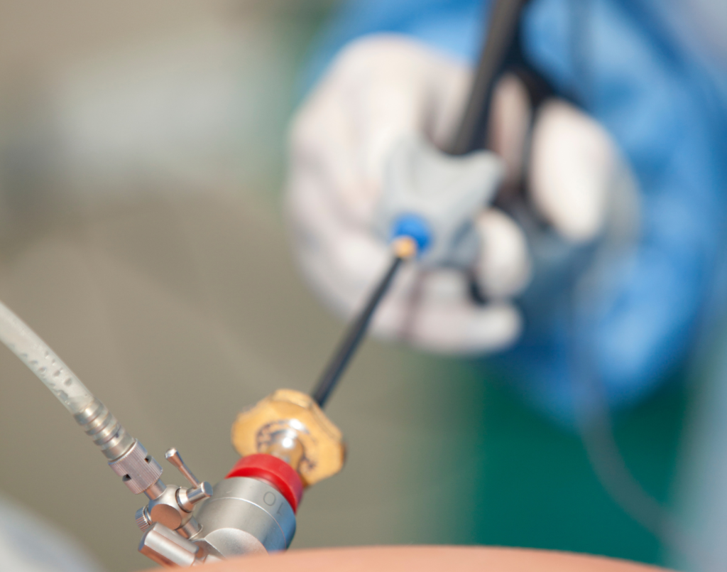 Laparoscopy